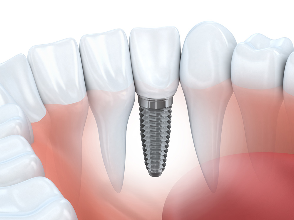 Five Myths About Dental Implants